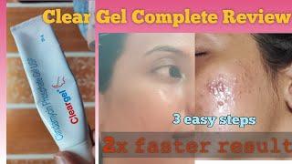 Get rid of acne pimple in 2x faster |clear gel | Dermadew acne soap