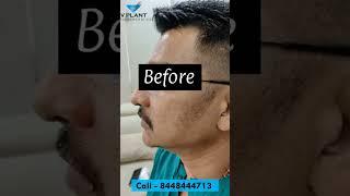 Beard transplant results after 6 months | Beard transplant results after 6 months in India