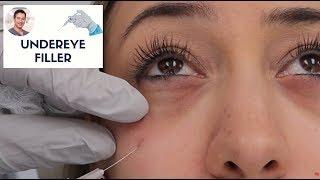 Undereye Filler By Leif Rogers, MD, FACS | Fanning Technique | Beverly Hills