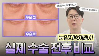 활기 넘치는 동안으로 변신! 눈밑지방재배치 수술 전후 비교 1주차, 2달차 환자 사진 리뷰