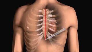 How Does Heart Bypass Surgery Work? Coronary Artery Bypass Graft Procedure Animation - CABG Video