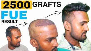 Hair Transplant Result of 28 Year Old Young Male || 2500 Grafts FUE || Regrow Clinic Haridwar