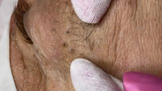 Blackhead Removal: Satisfying  Routine | 119