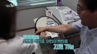 백반증 엑시머레이저 치료 [뷰티스맑은피부과][KBC 닥터365]