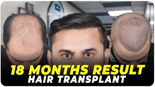 Hair Transplant in Trivandrum | Best Results & Cost of Hair Transplant in Trivandrum