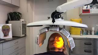 Cutera Laser Treatment for Sensitive Skin and Rosacea