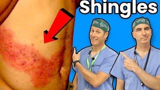 Shingles - You Definitely Don't Want This!