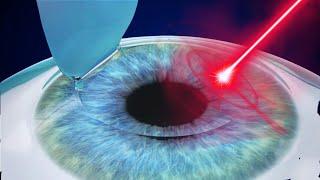 Is Laser Eye Surgery Worth It？ 