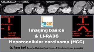 Imaging for Liver Cancer & LI-RADS -Hepatocellular carcinoma radiology masterclass - Edusurg clinics