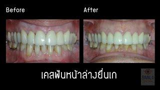 จัดฟัน invisalign เคสฟันเก จัดเฉพาะฟันล่าง