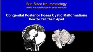 Posterior Fossa Cystic Malformations Made Easy - How To Tell Them Apart