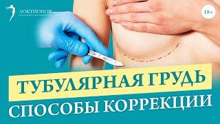 Как исправить тубулярную форму груди? Методы лечения / 18+