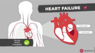 Symptoms of Heart Failure | MediGence