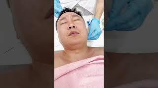 Косметическое иглоукалывание #иглоукалывание #рефлексотерапия #acupressure #acupunсture #massage