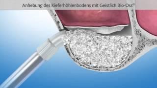 Knochenaufbau mit Sinuslift | Patienten Information