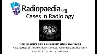 Renal cell carcinoma in a patient with colonic diverticulitis (Radiopaedia.org) Cases in Radiology