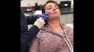 Lip fillers with cannula. Calvin Lee, MD Modesto