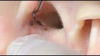 THE MOST VIEW...FOUR BIG BLACKHEADS ON THE EAR...SATISFYING VIDEO #2 #relaxing #blackheads