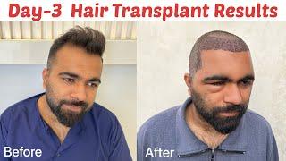 My Hair Transplant Results after 3 Days | Swelling after Hair Transplant | How to clean Donor area|