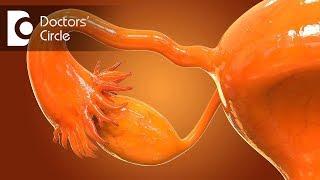 With what size of follicle in PCOS can one conceive?-Dr. Geeta Komar