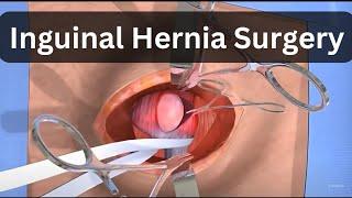 inguinal hernia surgery | inguinal hernia surgery recovery | right inguinal hernia repair