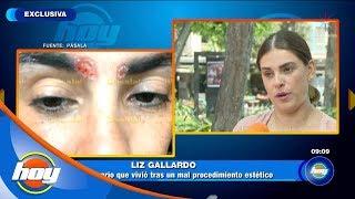 Liz Gallardo pudo perder la vida a causa de un mal tratamiento estético | Hoy