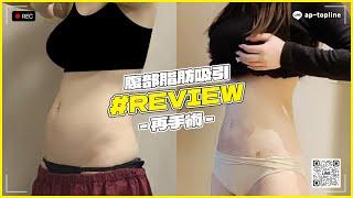 【狎鴎亭トップライン】腹部脂肪吸引再手術 1ヶ月目REVIEW!