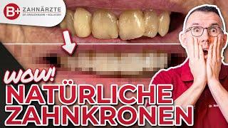 Neues Lächeln mit 6 Zahn Kronen - Smile Makeover Oberkiefer - inklusive Vorher / Nachher!