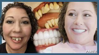 Before and After Pictures of the 3 on 6 Dental Implants - A Life-Changing New Procedure