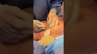 Breast augmentation with Dr. Bruno  #breastaugmentationsurgery #breastimplantsurgery #shorts