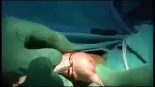 Leaking. Original video lucinta luna genital surgery.