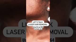 Laser hair removal for black skin using ND-yag 1064nm |Fotona Laser