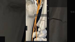 Перелом и Повреждение нерва #анатомия #anatomy #биология #массаж #bodyanatomy