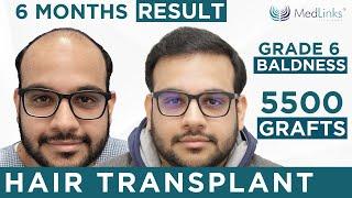 Best Hair Transplant Results in India | Celebrity Hair Transplant Clinic in India