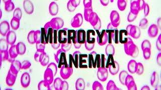 Microcytic Anemia (updated 2021) - CRASH! Medical Review Series