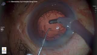 Dr Sourabh Patwardhan Live Cataract surgery. For training and consultation call 7028402375