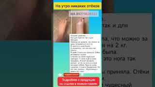 отек, отеки ног, отекают ноги, отёчность