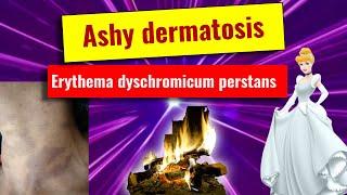 Ashy dermatoses, Erythema dyschromicum perstans: overview, features, histology, management