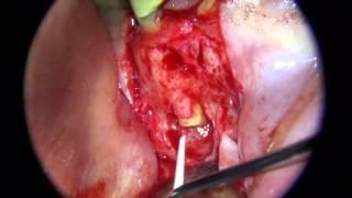 Micro-surgical endo - removing material from post-space void UL3