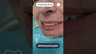Эффект ДО и ПОСЛЕ. Имплантация зубов пациенту.