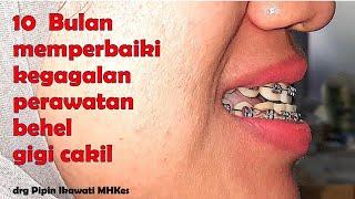 10 bulan perawatan behel gigi cameh, dokter gigi jogja perawatan behel gigi cakil karena behel gagal
