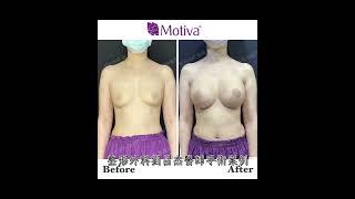 【 隆乳案例特輯· 筋膜下案例】隆乳五大重點之「層次」：筋膜下隆乳特輯。#隆乳 #魔滴 #腋下隆乳#motiva #breastaugmentation #劉昌杰醫師