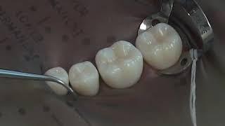 Rubber Dam Isolation | Operative Dentistry