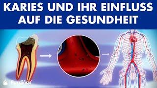 Karies und ihr Einfluss auf die Gesundheit ©