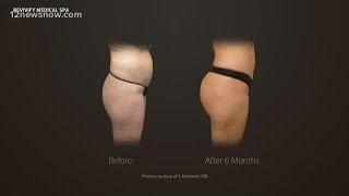 Revivify Medical Spa offers non-surgical liposuction