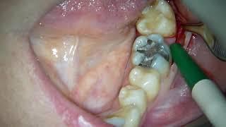 flap design in 3d molar extraction