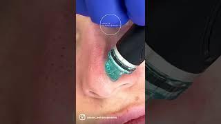 Blackheads Be Gone! - Hydrafacial ASMR 