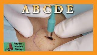 Biopsy ABCDE | Auburn Medical Group