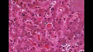 Histopathology Liver--Hemochromatosis
