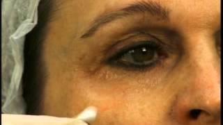 Dr. Elliott of Skinspirations Shows How to Fill Tear Troughs & Eye Depressions With Dermal Fillers